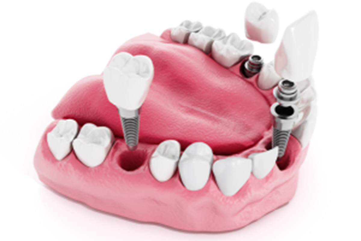 reasons-for-dental-implants