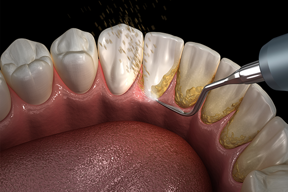 periodontal-disease-a-review