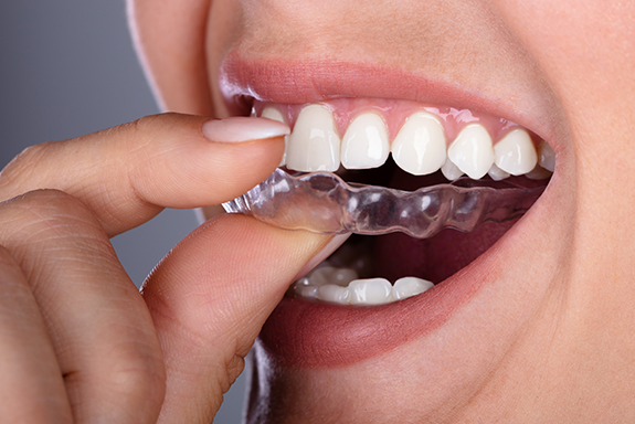 researchers-are-creating-a-smart-mouth-guard