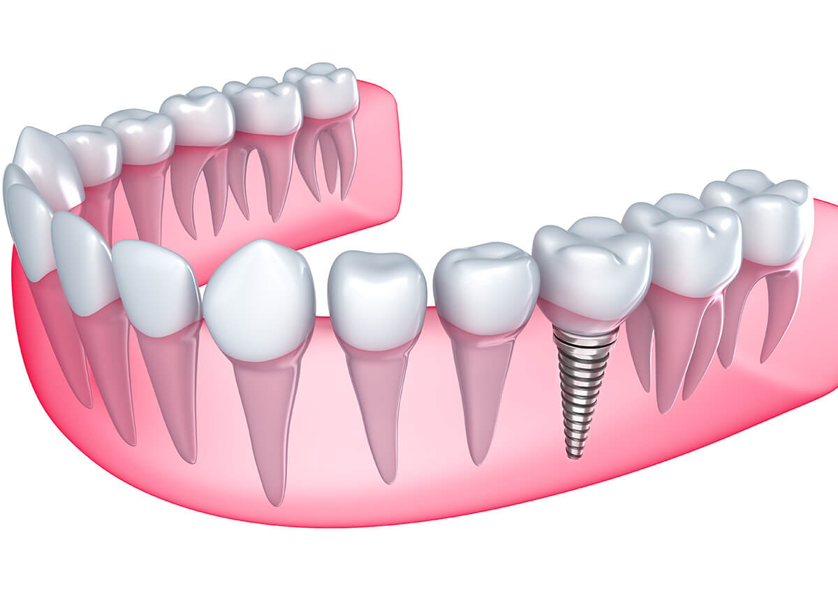 Implants for Teeth in Hamden CT Area