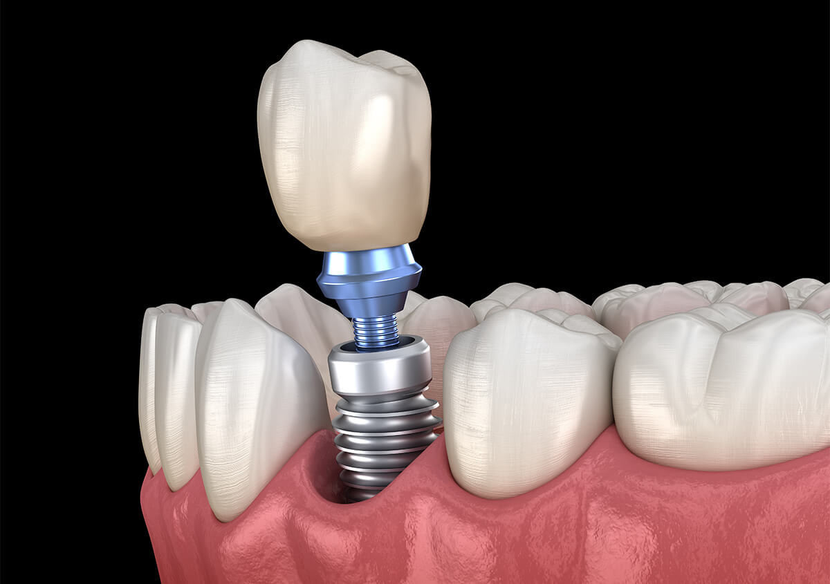 Natural Looking Dental Implants in Hamden CT Area